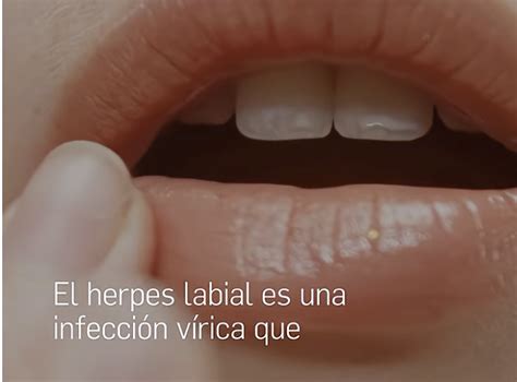 Herpes Labial Anestésico Local - Verifica RTVE y y Tu Farmacéutico informa. Herpes labial | Revista ...