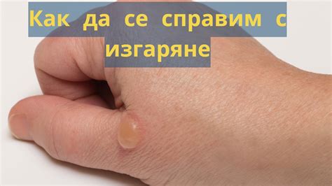 Как се лекуват изгаряния по кожата - Kak.lol