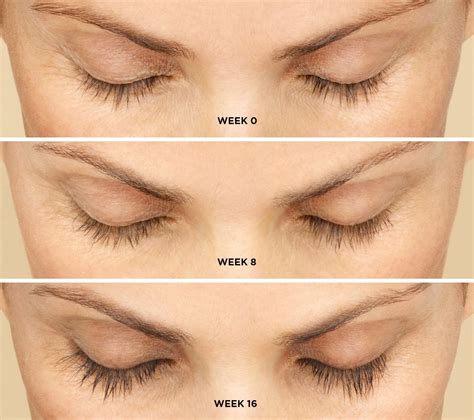 Latisse for Eyelash Growth – Synergy Medical Aesthetics – Nanaimo ...
