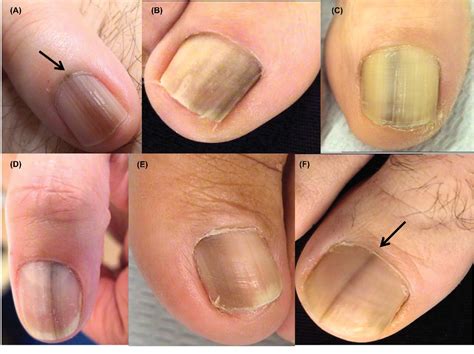 Dark Lines Under Fingernails Melanoma at Aaron Edwards blog