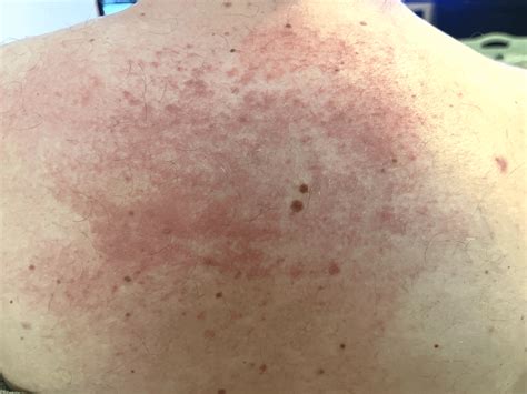 Unveiling The Hidden Dangers Of Early Stage First Stage Lamictal Rash