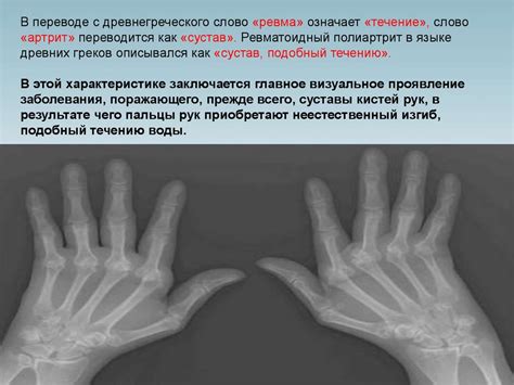 Ревматоидный полиартрит - презентация онлайн