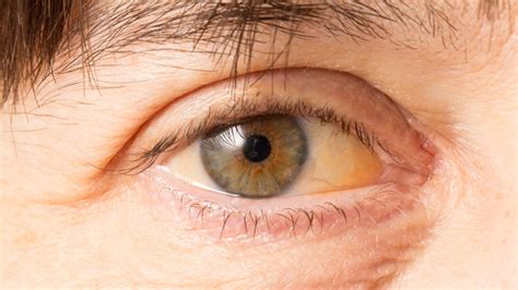 Yellowing Under The Eyes - Infoupdate.org