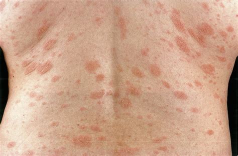 Pityriasis Rosea Stock Photos, Royalty Free Pityriasis, 56% OFF