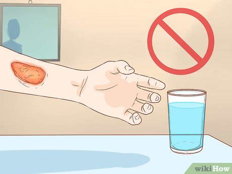 how to treat an infected burn at home
