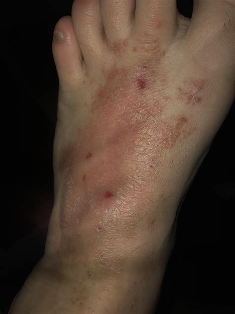 Discover What Do It Mean When Your Foot Itch According To Common Medical Explanations 8