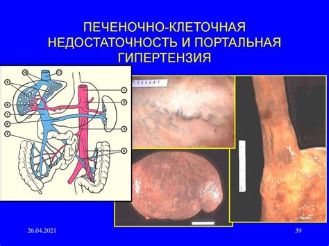 Болезни печени, желчного пузыря и поджелудочной железы - презентация онлайн