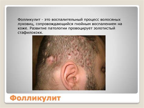 Заболевания кожи головы - презентация онлайн