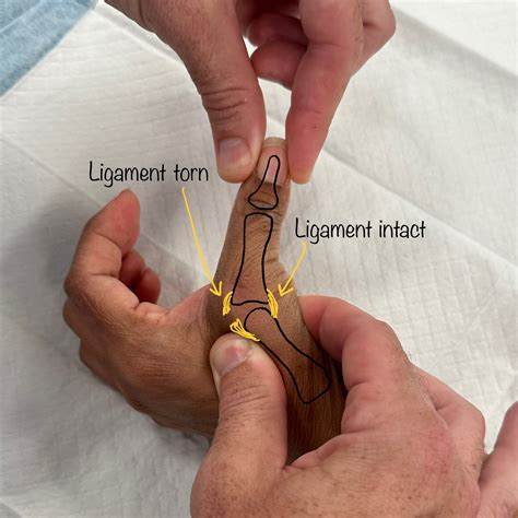 Thumb Ulnar Collateral Ligament (UCL) Repair | Dr Oscar Brumby-Rendell ...