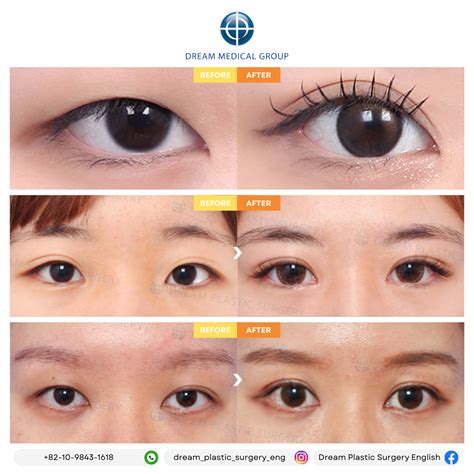 Double eyelid surgery before and after at dream plastic surgery clinic ...