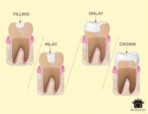 Fillings VS Inlay/Onlay VS Crown - Elite Dental Care