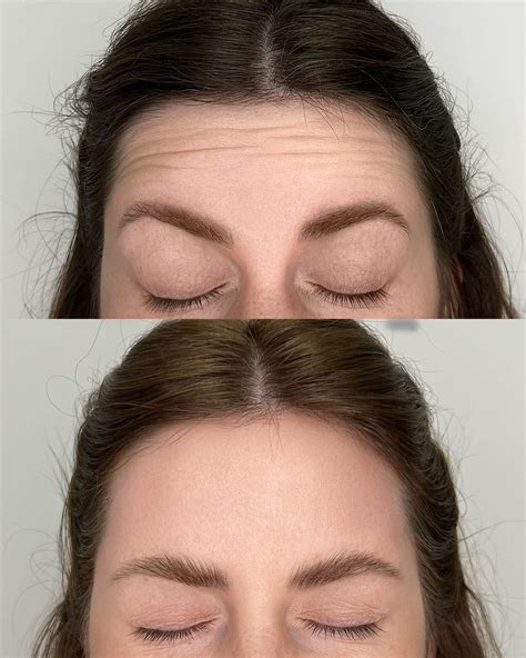 КОСМЕТОЛОГИЯ | ЛАЗЕРНАЯ ЭПИЛЯЦИЯ | RF ЛИФТИНГ | ИРКУТСК (@inaya.clinic ...