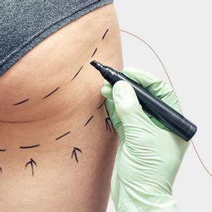 buttock augmentation surgery  mumbai sculpta aesthetics barc mumbai