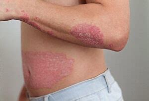 flexural psoriasis symptoms   treatment chandigarh ayurved