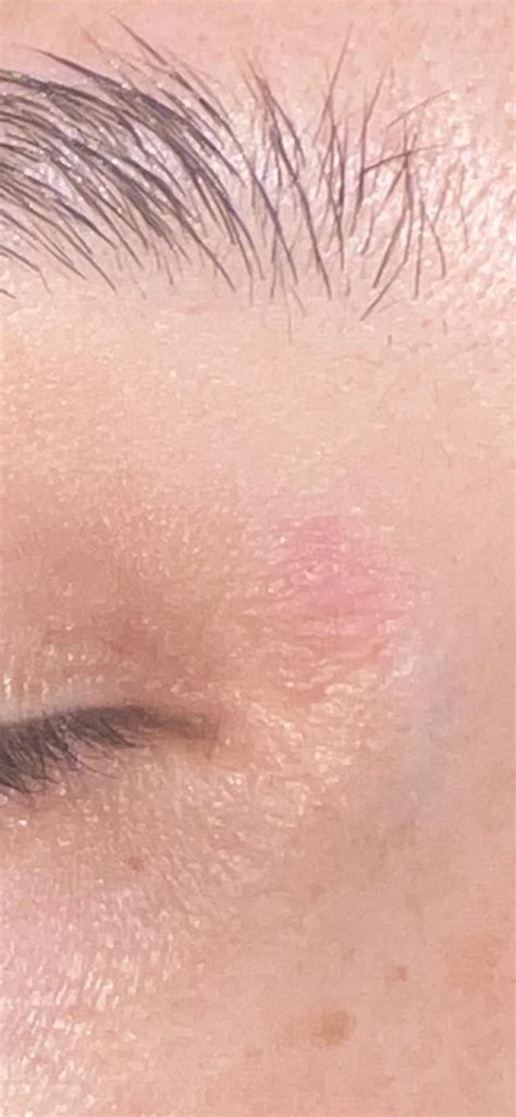 itchy spots rdermatologyquestions