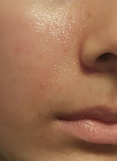 Is this an allergic reaction, breakout or barrier issue? [Acne] : r ...