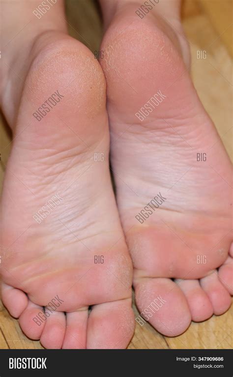 Dry Cracked Feet, Image & Photo (Free Trial) | Bigstock
