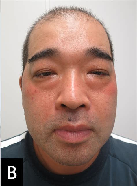 Periorbital swelling with crusted lesions: Drug reaction with