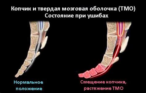 Ушиб копчика и крестца: причины, симптомы и методы лечения