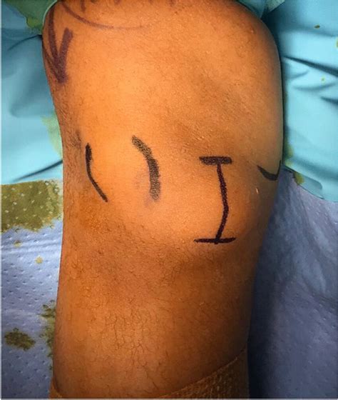 soft tissue mass   excision  scientific diagram