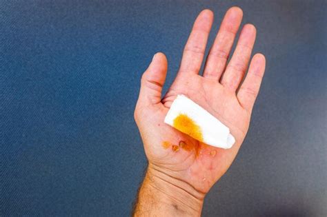 Palma herida con heridas y arañazos desinfectados con yodo para ...