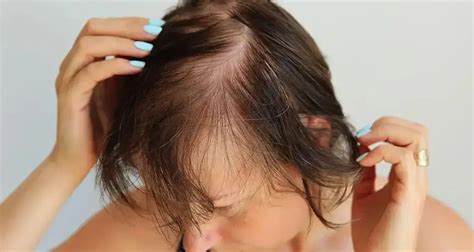 Why Does Ozempic Cause Hair Loss - Ozempicwire