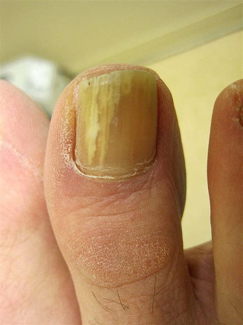 Toenail Polish Fungus