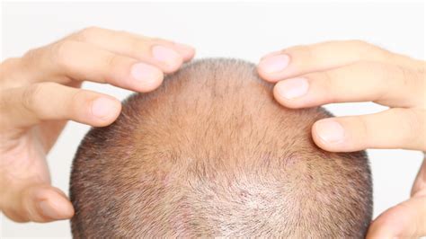 Le shock-loss, perte de cheveux après une greffe tout savoir sur ce ...