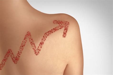 Можно ли купаться во время ветрянки? | MedAboutMe