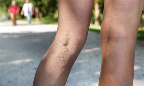 Does Genetics Cause Varicose Veins? Here’s What the Studies Say