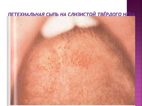 Инфекционный мононуклеоз - online presentation