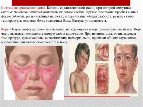 Лимфаденит. Лимфоузлы - online presentation