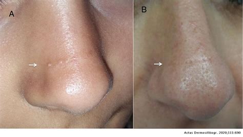 transverse nasal  actas dermo sifiliograficas