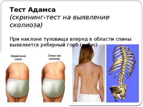 Сколиоз 3 степени: причины, симптомы, лечение