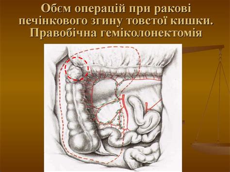 Рак ободової та прямої кишки - online presentation