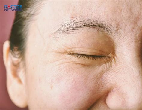 allergic  itchy face