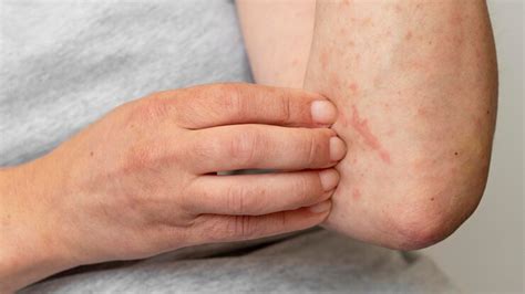 Érythème polymorphe : symptômes, causes, diagnostic et traitement