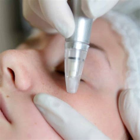 dermabrasion - NOWMI