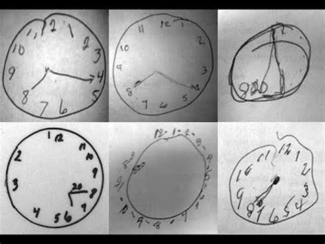 Teste Do Desenho Do Relógio - NEUROPSICOLOGIA - TESTE DO DESENHO DO RELÓGIO EM IDOSOS COM DECLÍNIO ...