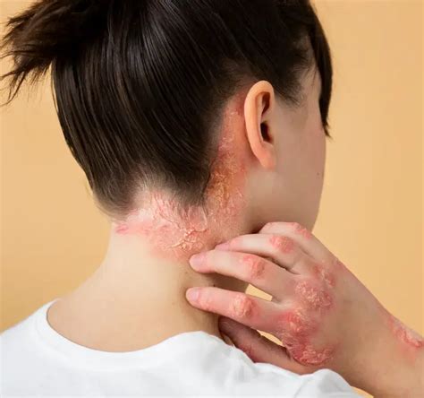 9 Home Remedies for Fungal Infections - Herb Dieter