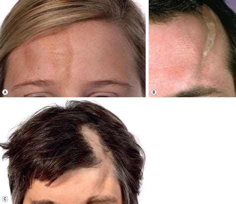 Morphea and Lichen Sclerosus - Clinical Tree