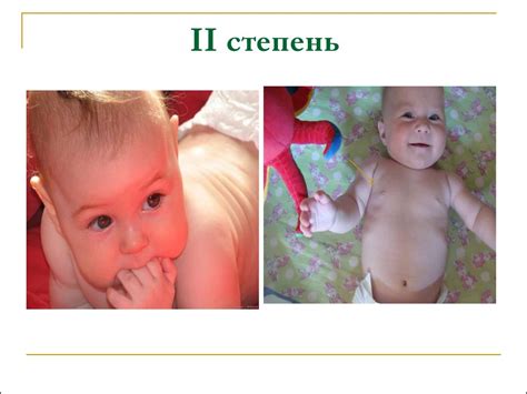 Минеральный обмен у детей. Рахит, диагностика, клиника, лечение ...