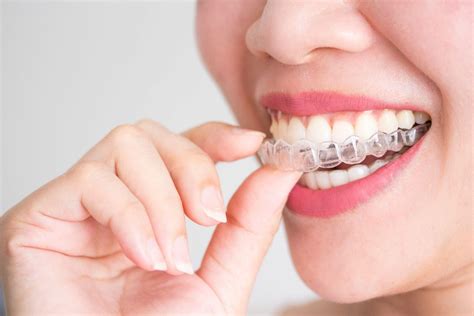 What Are Invisalign Attachments? | Smile Stories