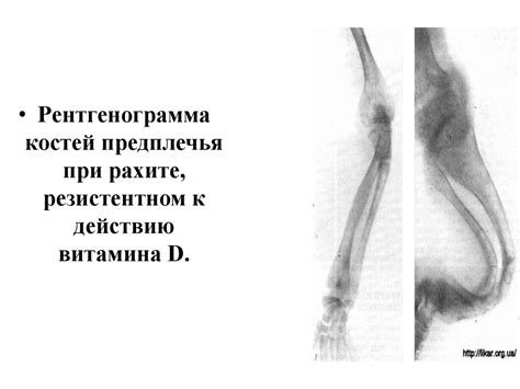 Болезнь Пертеса. Рахит и рахитоподобные заболевания. Диспластические ...