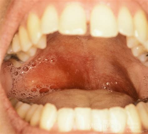 Peritonsillar Abscess Ultrasound Technique