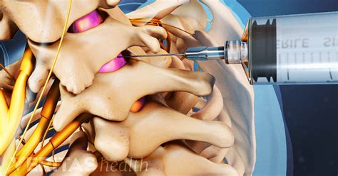Epidural Injection Procedure