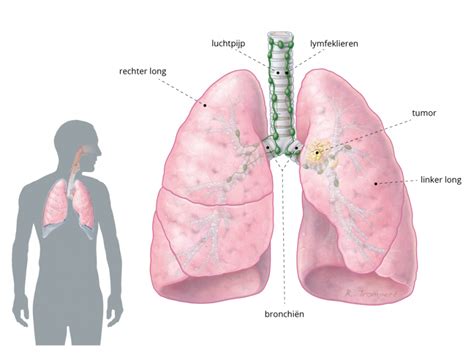 longkanker comprehensive cancer center
