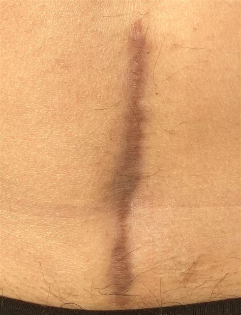 Surgical scar : r/PlasticSurgery