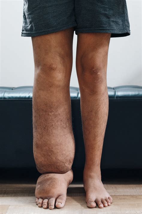 Dermatofibrom: Ursachen, Symptome & Behandlung