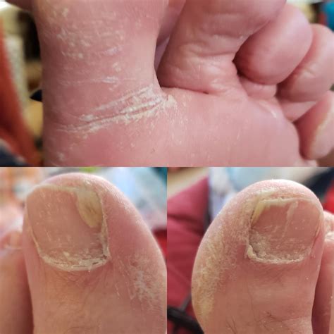 Is this a fungus on my husband's feet? He says not itchy : r/Dermatology